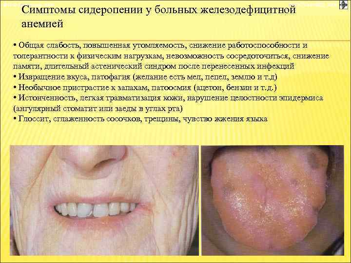 © П. Ф. Литвицкий, 2004 © ГЭОТАР-МЕД, 2004 Симптомы сидеропении у больных железодефицитной анемией