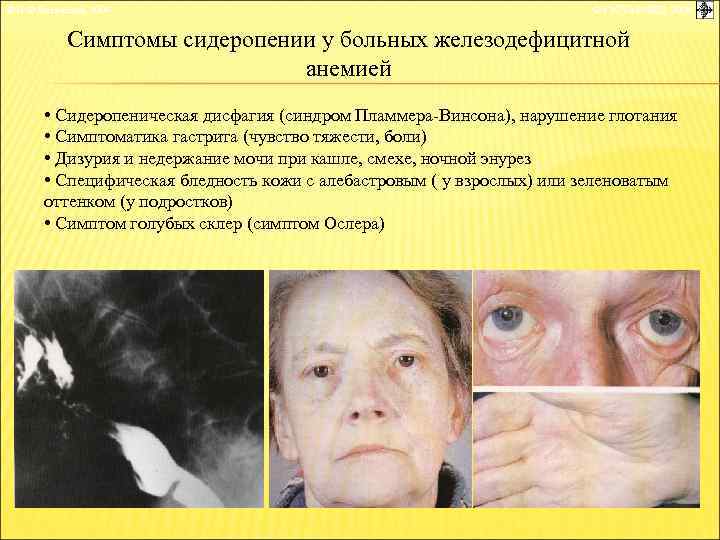 © П. Ф. Литвицкий, 2004 © ГЭОТАР-МЕД, 2004 Симптомы сидеропении у больных железодефицитной анемией