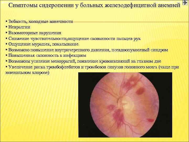 © П. Ф. Литвицкий, 2004 © ГЭОТАР-МЕД, 2004 Симптомы сидеропении у больных железодефицитной анемией