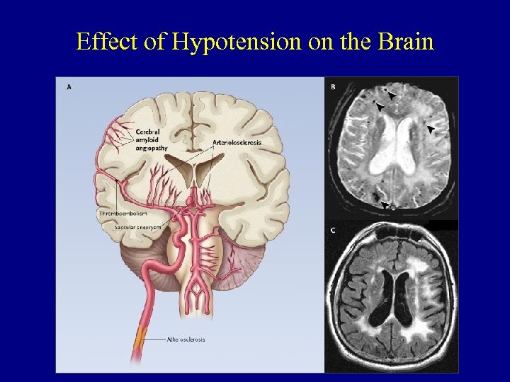 Effect of Hypotension on the Brain 