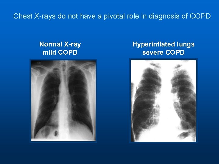 Chest X-rays do not have a pivotal role in diagnosis of COPD Normal X-ray