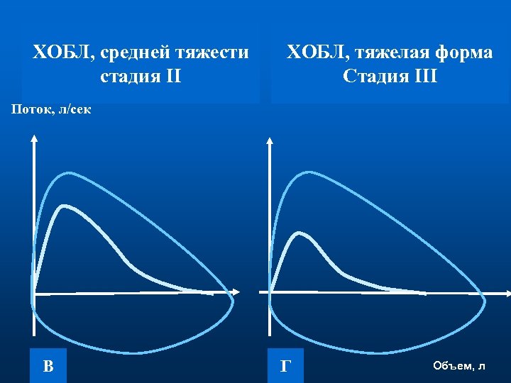 ХОБЛ, средней тяжести стадия II ХОБЛ, тяжелая форма Стадия III Поток, л/сек В Г