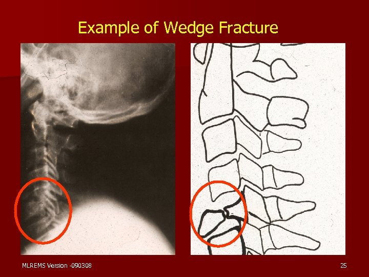 Example of Wedge Fracture MLREMS Version -090308 25 