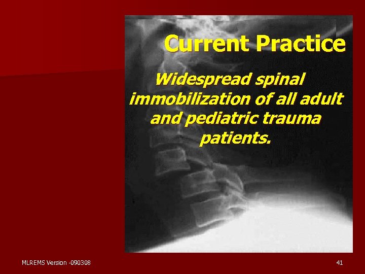 Current Practice Widespread spinal immobilization of all adult and pediatric trauma patients. MLREMS Version