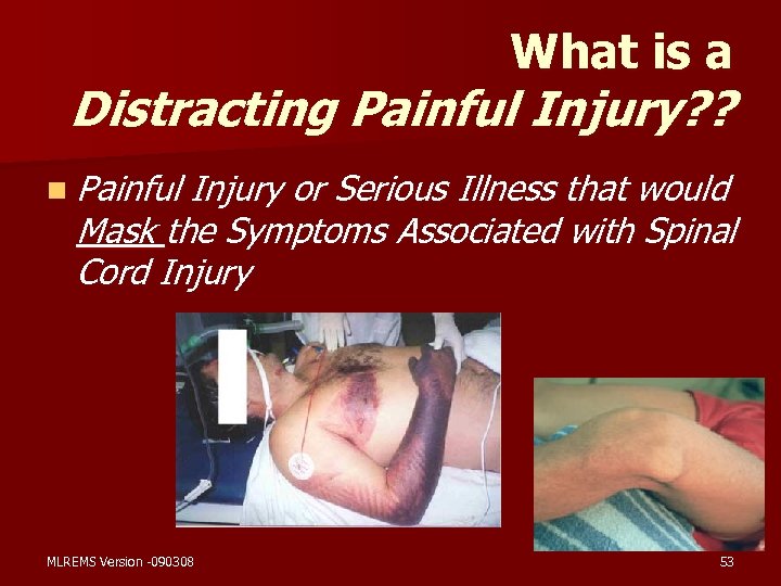 What is a Distracting Painful Injury? ? n Painful Injury or Serious Illness that