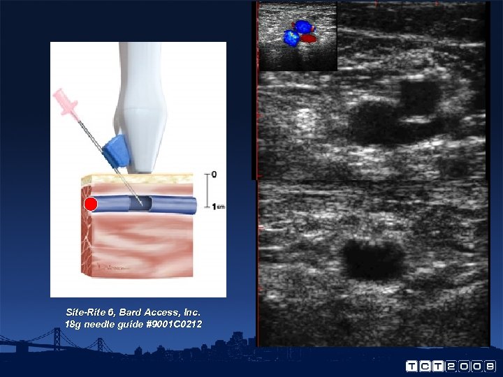 Site-Rite 6, Bard Access, Inc. 18 g needle guide #9001 C 0212 