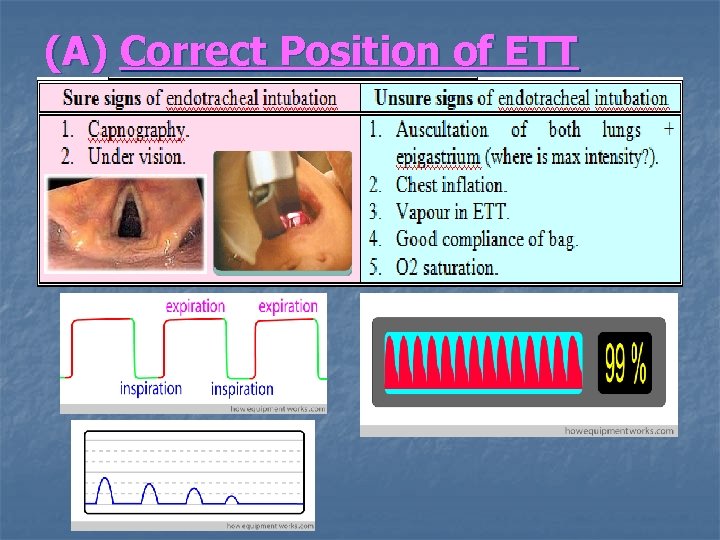 (A) Correct Position of ETT 