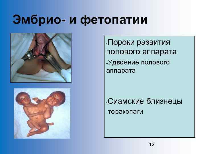 Эмбрио- и фетопатии Пороки развития полового аппарата • Удвоение полового аппарата – • Сиамские