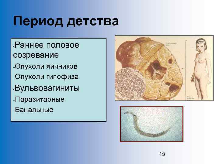 Период детства Раннее половое созревание • Опухоли яичников –Опухоли гипофиза – • Вульвовагиниты Паразитарные