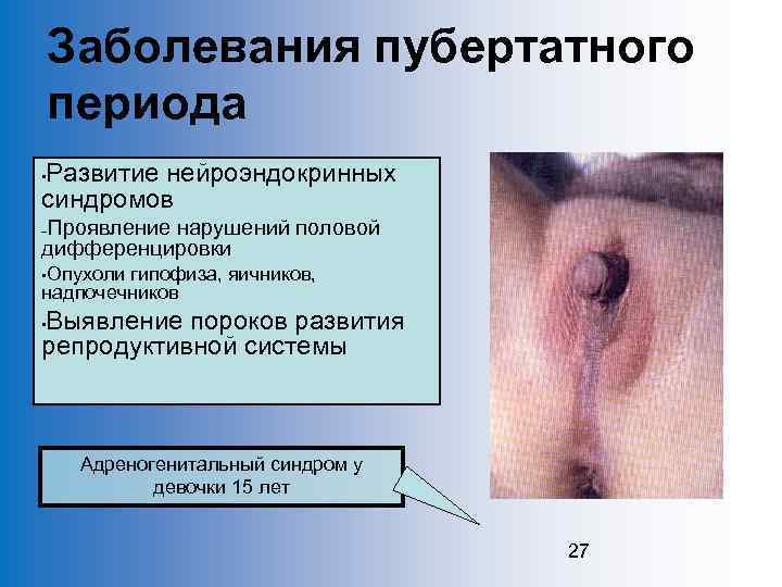 Заболевания пубертатного периода Развитие нейроэндокринных синдромов • Проявление нарушений половой дифференцировки – • Опухоли