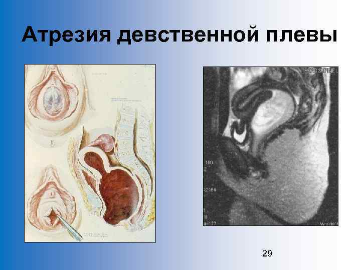 Атрезия девственной плевы 29 