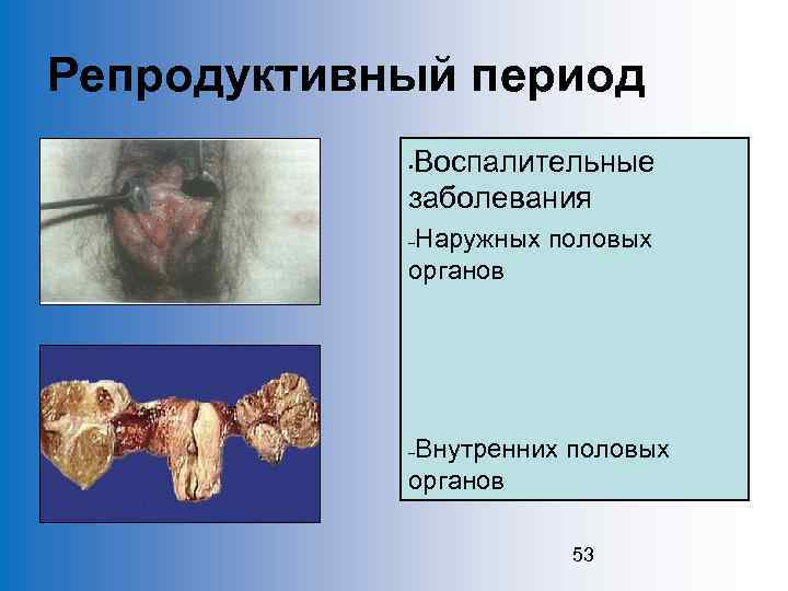 Репродуктивный период Воспалительные заболевания • Наружных половых органов – Внутренних половых органов – 53