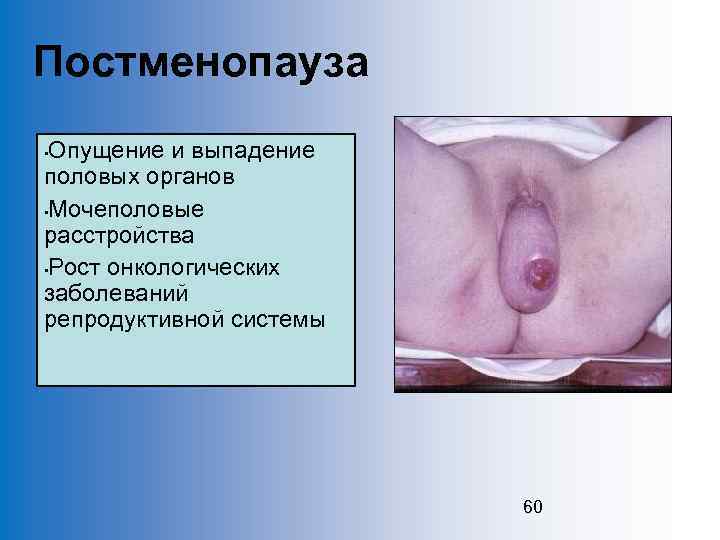 Постменопауза Опущение и выпадение половых органов • Мочеполовые расстройства • Рост онкологических заболеваний репродуктивной