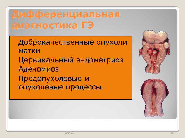 Дифференциальная диагностика ГЭ Доброкачественные опухоли матки Цервикальный эндометриоз Аденомиоз Предопухолевые и опухолевые процессы ВМед.