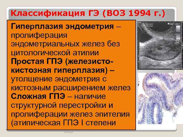 Классификация ГЭ (ВОЗ 1994 г. ) Гиперплазия эндометрия – пролиферация эндометриальных желез без цитологической