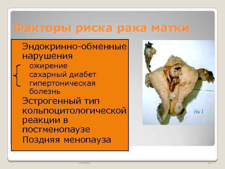 Факторы риска рака матки Эндокринно-обменные нарушения ◦ ожирение ◦ сахарный диабет ◦ гипертоническая болезнь