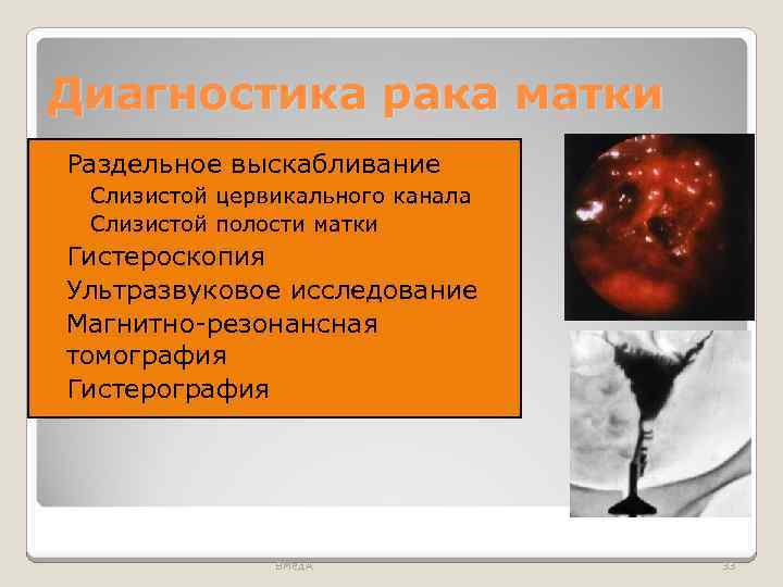 Диагностика рака матки Раздельное выскабливание ◦ Слизистой цервикального канала ◦ Слизистой полости матки Гистероскопия