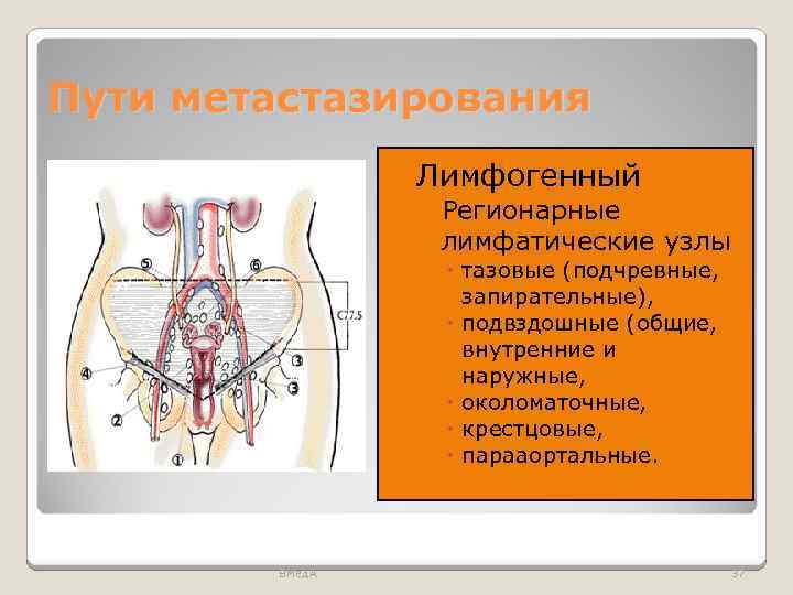 Пути метастазирования Лимфогенный • Регионарные лимфатические узлы тазовые (подчревные, запирательные), подвздошные (общие, внутренние и