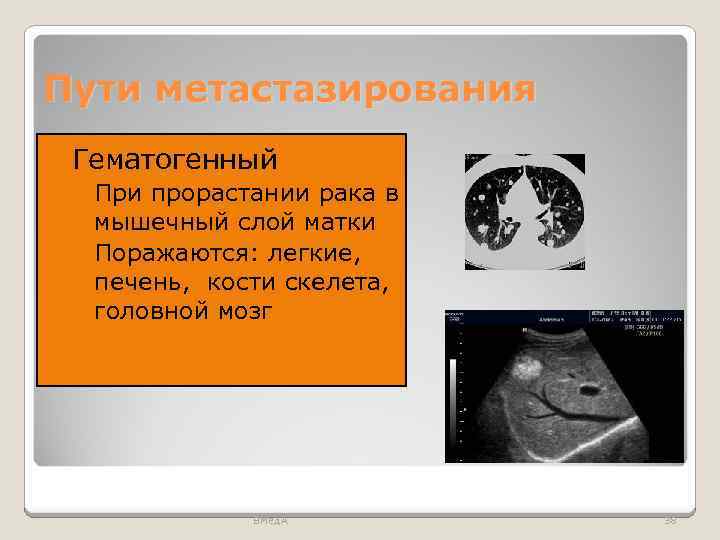 Пути метастазирования Гематогенный ◦ При прорастании рака в мышечный слой матки ◦ Поражаются: легкие,