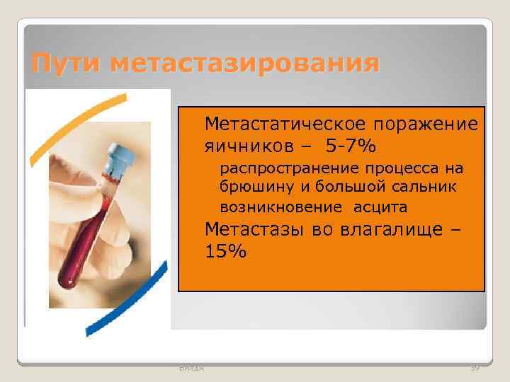 Пути метастазирования Метастатическое поражение яичников – 5 -7% ◦ распространение процесса на брюшину и