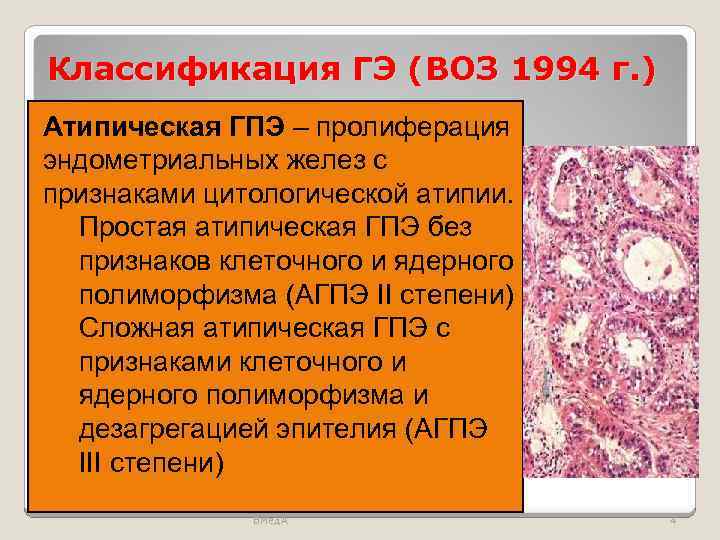 Классификация ГЭ (ВОЗ 1994 г. ) Атипическая ГПЭ – пролиферация эндометриальных желез с признаками
