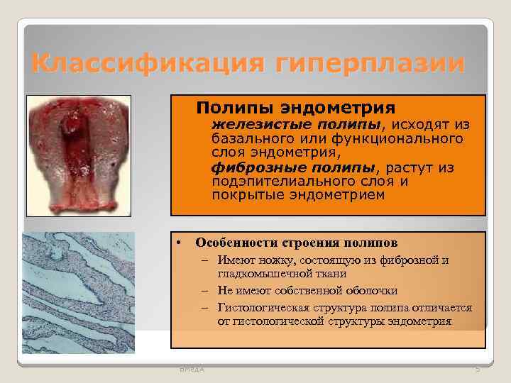 Классификация гиперплазии Полипы эндометрия ◦ железистые полипы, исходят из базального или функционального слоя эндометрия,