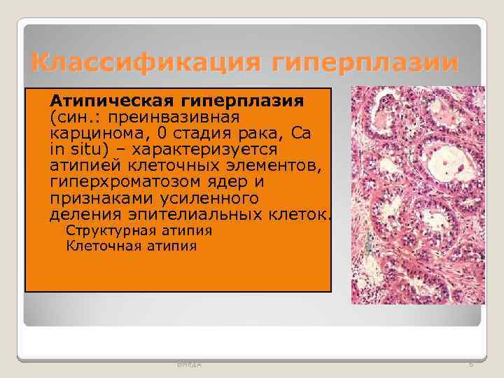 Классификация гиперплазии Атипическая гиперплазия (син. : преинвазивная карцинома, 0 стадия рака, Са in situ)