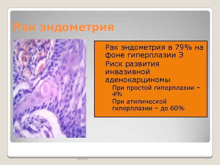 Рак эндометрия в 79% на фоне гиперплазии Э Риск развития инвазивной аденокарциномы ◦ При