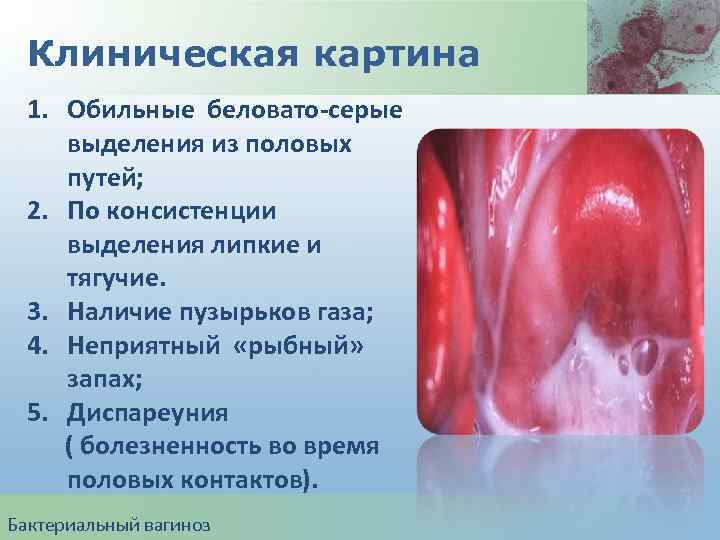 Клиническая картина 1. Обильные беловато-серые выделения из половых путей; 2. По консистенции выделения липкие