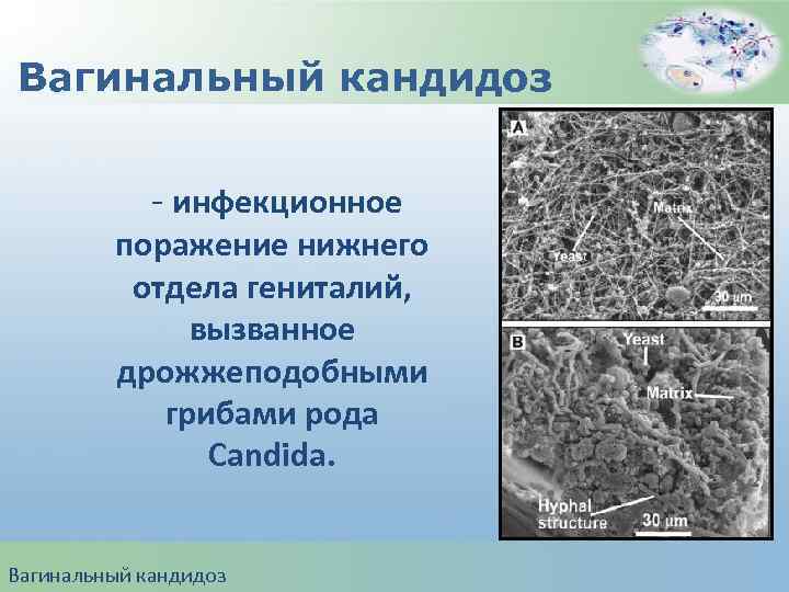 Вагинальный кандидоз - инфекционное поражение нижнего отдела гениталий, вызванное дрожжеподобными грибами рода Candida. Вагинальный