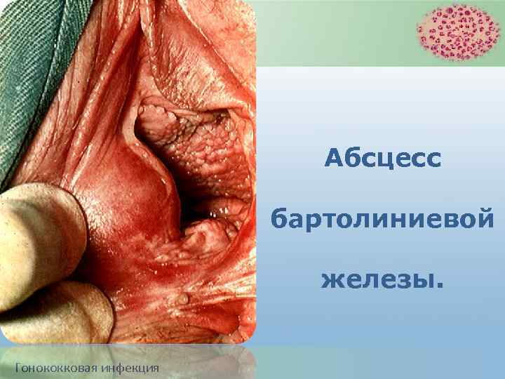 Абсцесс бартолиниевой железы. Гонококковая инфекция 