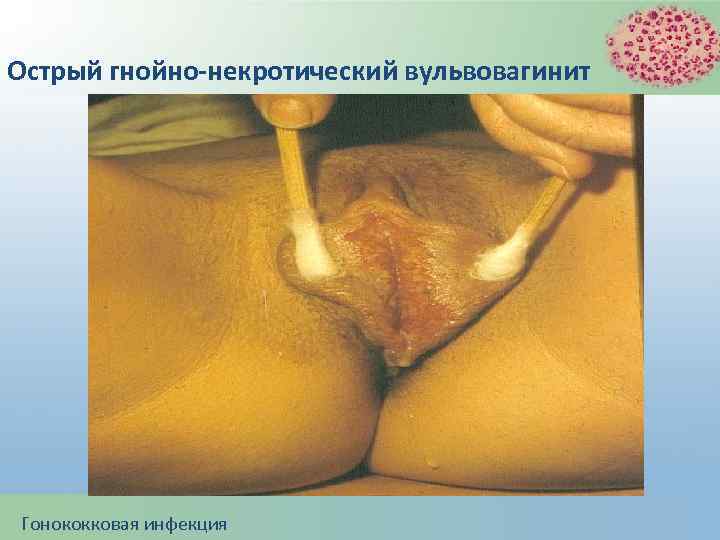 Острый гнойно-некротический вульвовагинит Гонококковая инфекция 