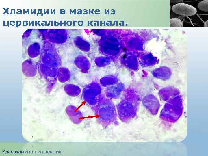 Хламидии в мазке из цервикального канала. Хламидийная инфекция 