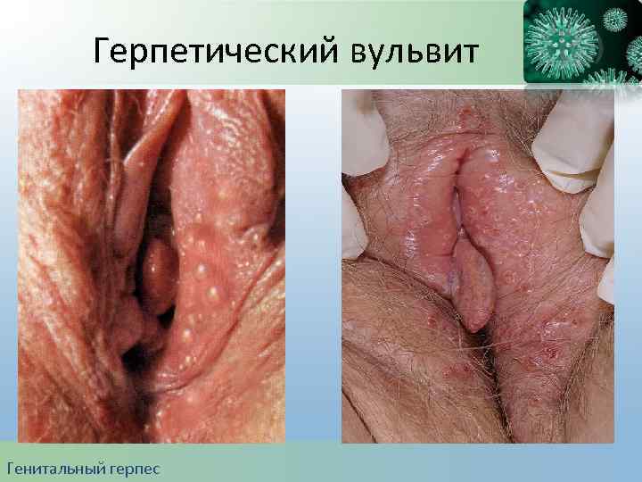 Герпетический вульвит Генитальный герпес 