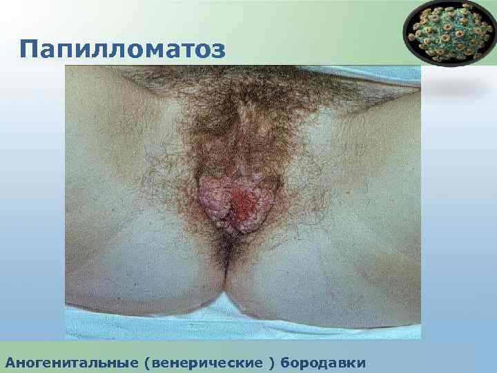 Папилломатоз Аногенитальные (венерические ) бородавки 
