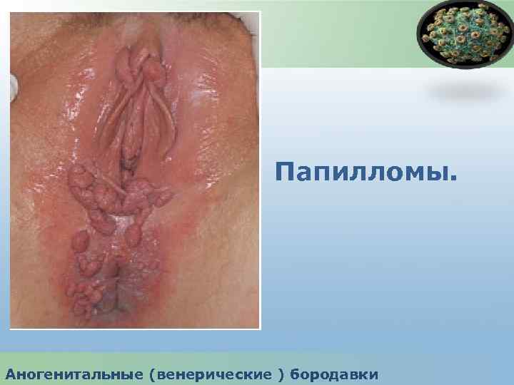 Папилломы. Аногенитальные (венерические ) бородавки 