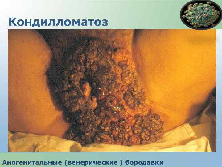 Кондилломатоз Аногенитальные (венерические ) бородавки 