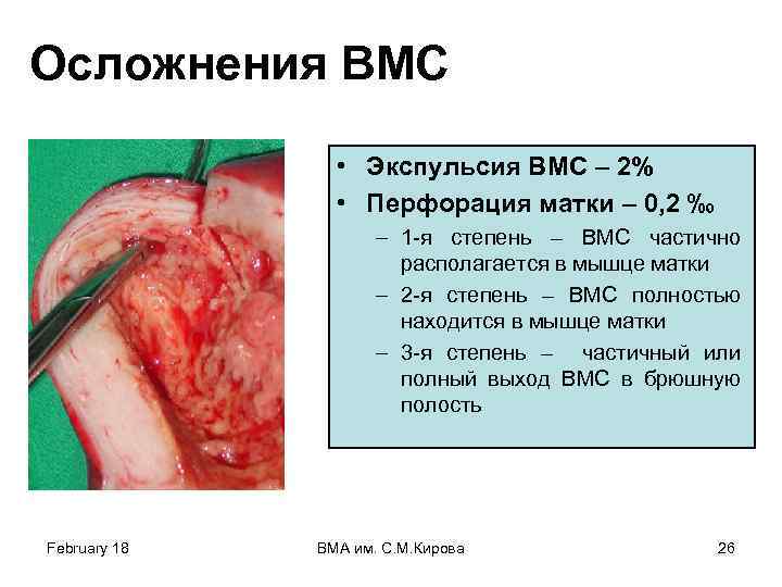 Осложнения ВМС • Экспульсия ВМС – 2% • Перфорация матки – 0, 2 ‰