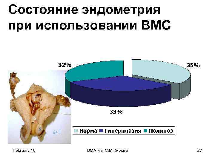 Состояние эндометрия при использовании ВМС February 18 ВМА им. С. М. Кирова 27 