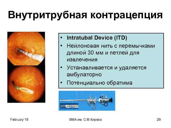 Внутритрубная контрацепция • Intratubal Device (ITD) • Нейлоновая нить с перемычками длиной 30 мм