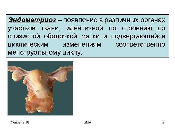 Эндометриоз – появление в различных органах участков ткани, идентичной по строению со слизистой оболочкой
