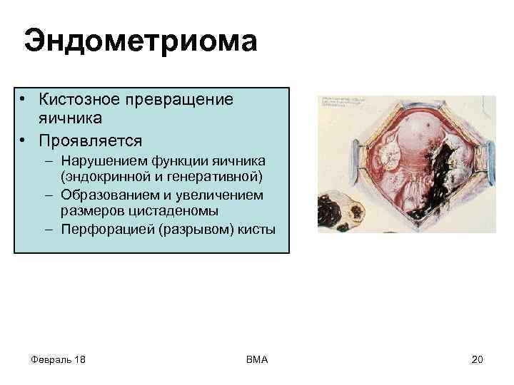 Эндометриома • Кистозное превращение яичника • Проявляется – Нарушением функции яичника (эндокринной и генеративной)