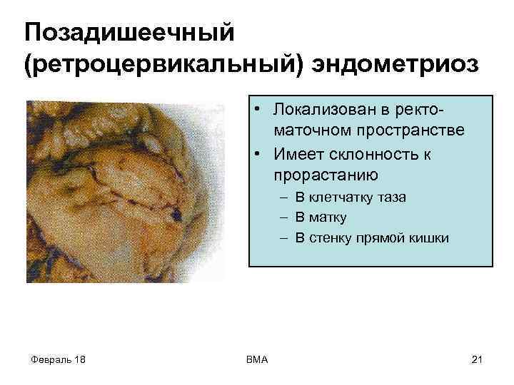 Позадишеечный (ретроцервикальный) эндометриоз • Локализован в ректоматочном пространстве • Имеет склонность к прорастанию –