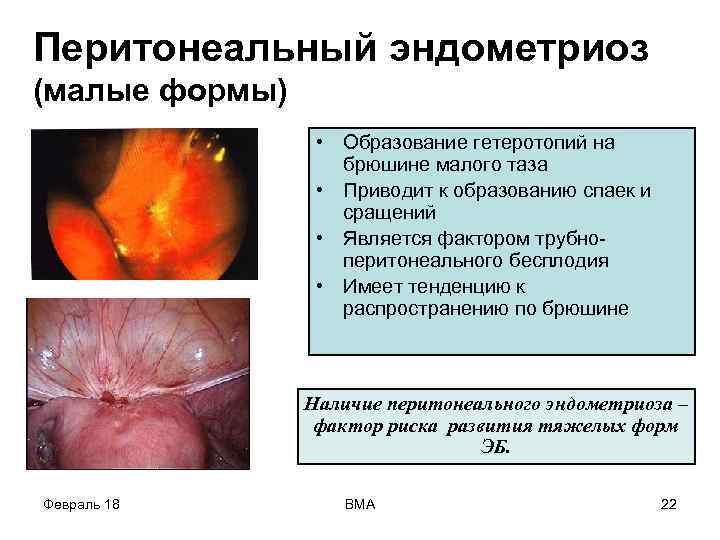 Перитонеальный эндометриоз (малые формы) • Образование гетеротопий на брюшине малого таза • Приводит к
