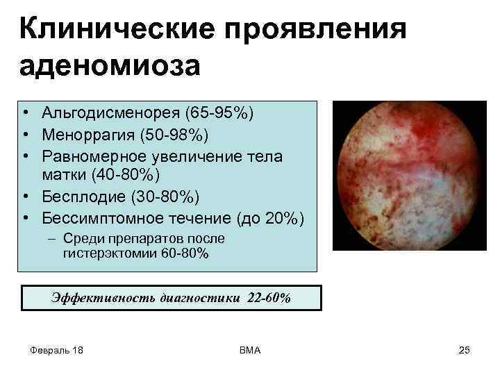 Клинические проявления аденомиоза • Альгодисменорея (65 -95%) • Меноррагия (50 -98%) • Равномерное увеличение