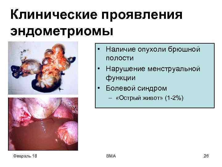 Клинические проявления эндометриомы • Наличие опухоли брюшной полости • Нарушение менструальной функции • Болевой