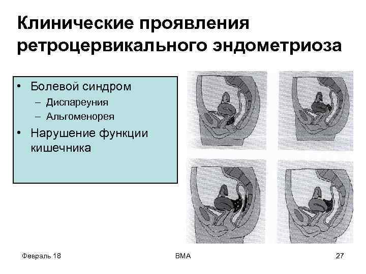 Клинические проявления ретроцервикального эндометриоза • Болевой синдром – Диспареуния – Альгоменорея • Нарушение функции