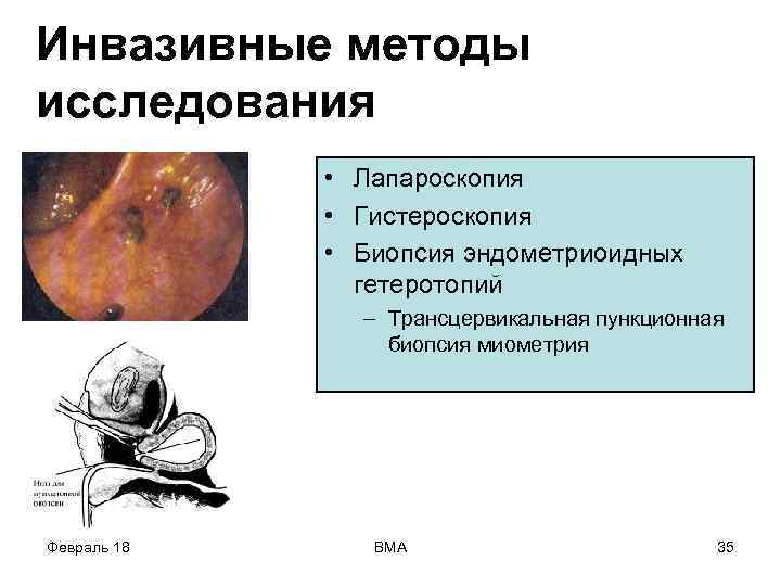 Инвазивные методы исследования • Лапароскопия • Гистероскопия • Биопсия эндометриоидных гетеротопий – Трансцервикальная пункционная