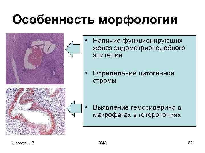 Особенность морфологии • Наличие функционирующих желез эндометриоподобного эпителия • Определение цитогенной стромы • Выявление