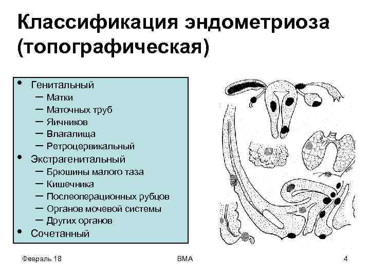 Классификация эндометриоза (топографическая) • Генитальный • Экстрагенитальный • Сочетанный – Матки – Маточных труб